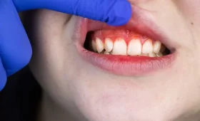 10 Hal yang Harus Dihindari agar Gusi Tidak Berdarah